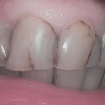 Before veneers
