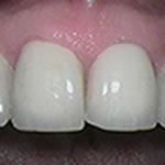 After veneers