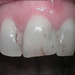 Before Veneers