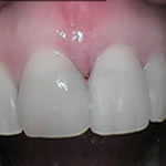 After Veneers