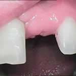 Before implant