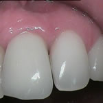 After implant