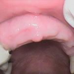 Before implants