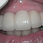 After Implants